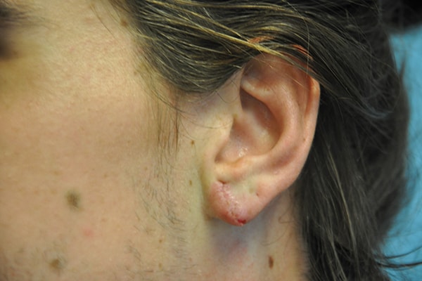 Ears Surgery Photos