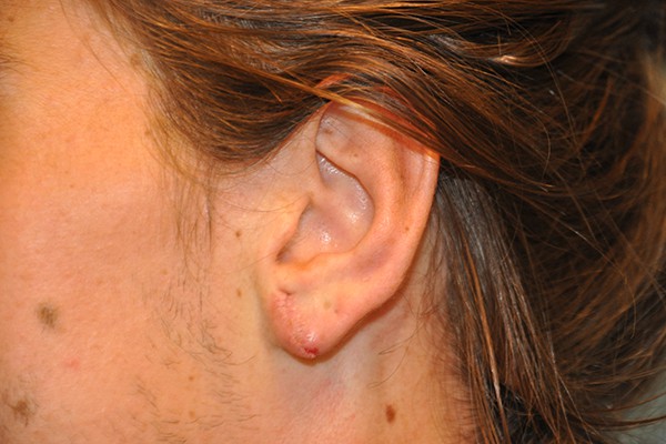 Ears Surgery Photos