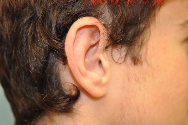 Ears Surgery Photos