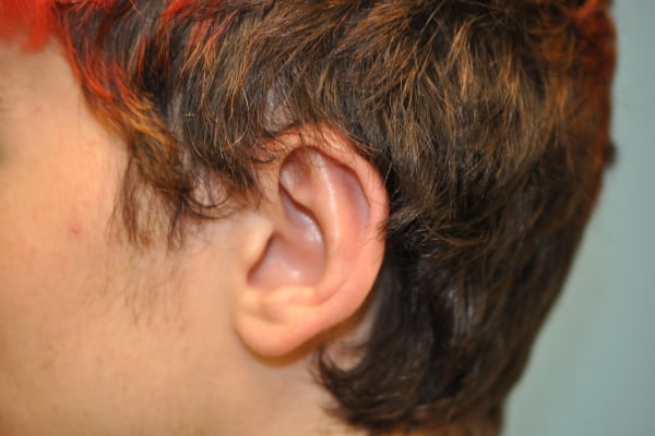 Ears Surgery Photos