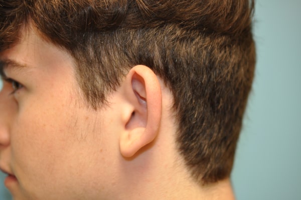 Ears Surgery Photos