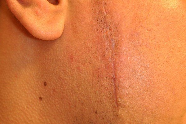 Scar Revision Photos