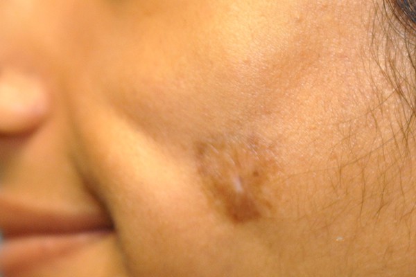 Scar Revision Photos