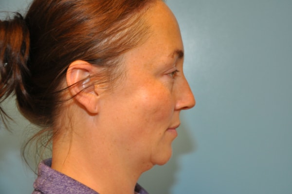 Facelift Surgery Photos