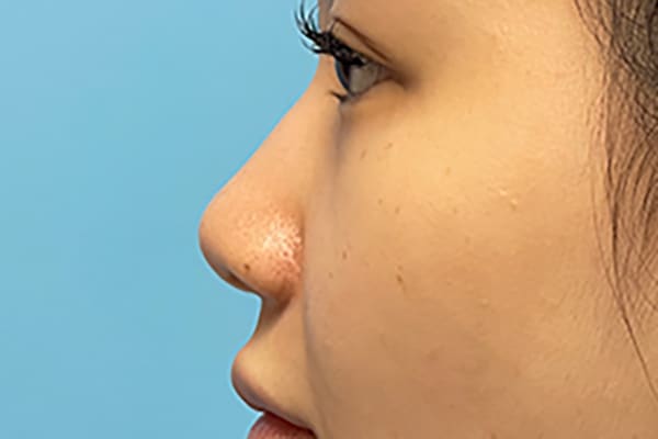 Nose Photos