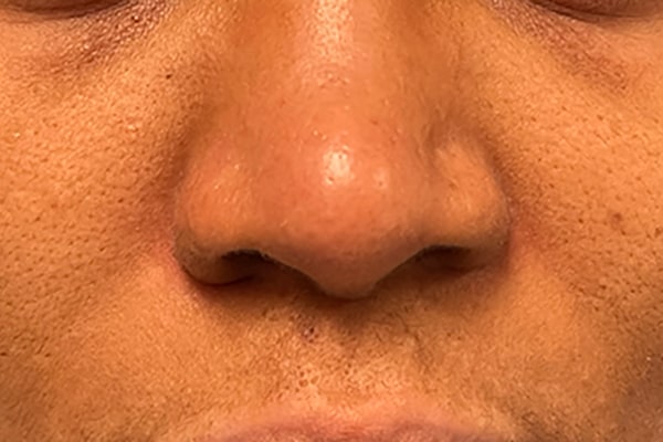 Nose Photos