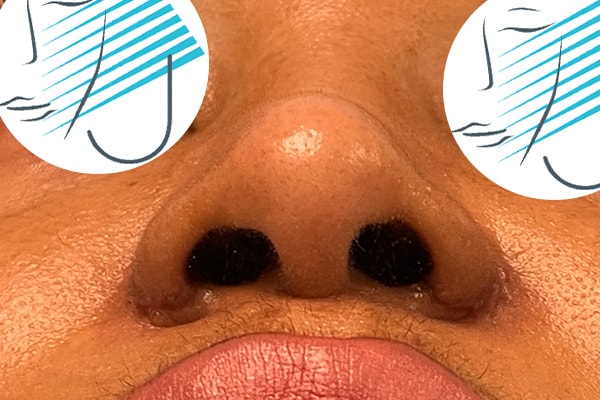 Nose Photos