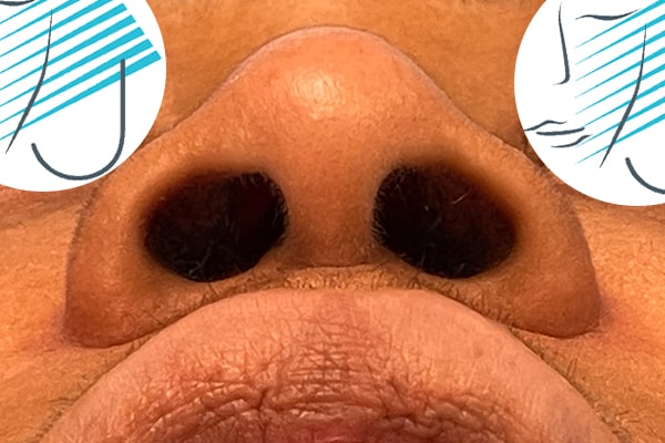 Nose Photos