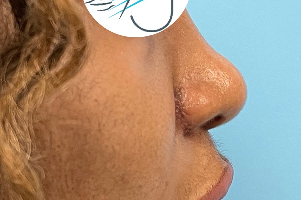 Nose Photos