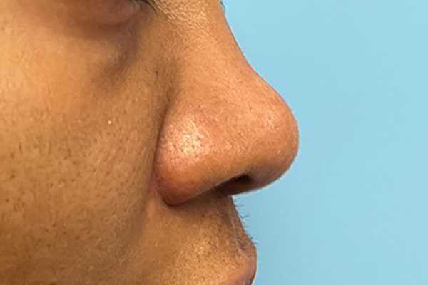 Nose Photos