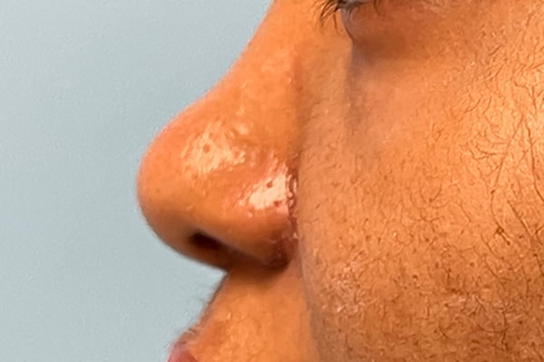 Nose Photos