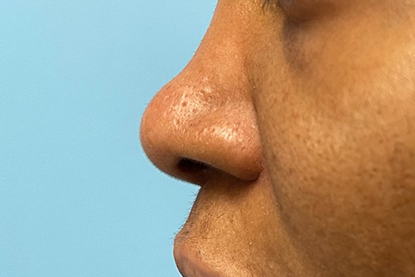 Nose Photos