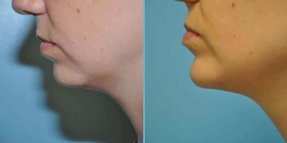 Chin Implant Photos