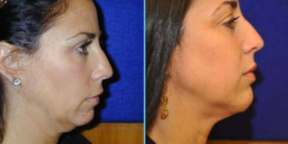 Chin Implant Photos