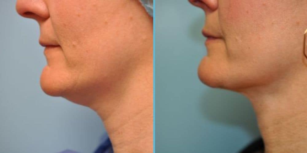 Chin Implant Photos