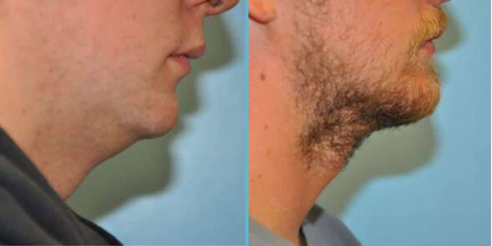 Chin Implant Photos