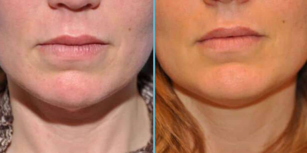 Chin Implant Photos