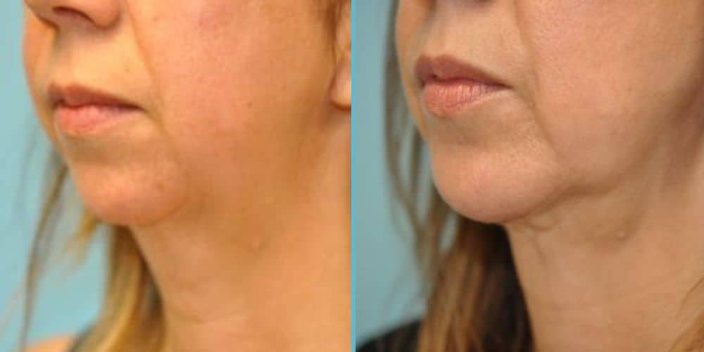 Chin Implant Photos