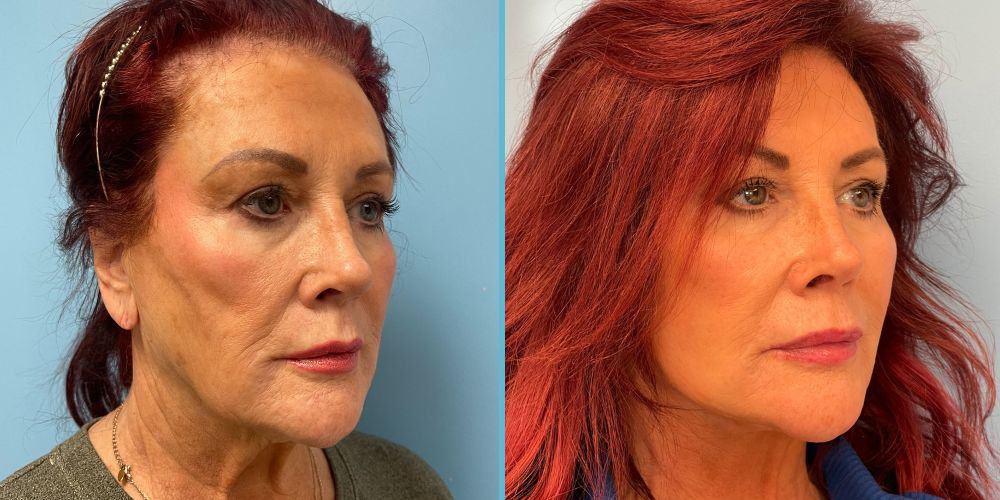 Facelift Surgery Photos