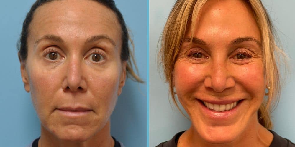 Facelift Surgery Photos