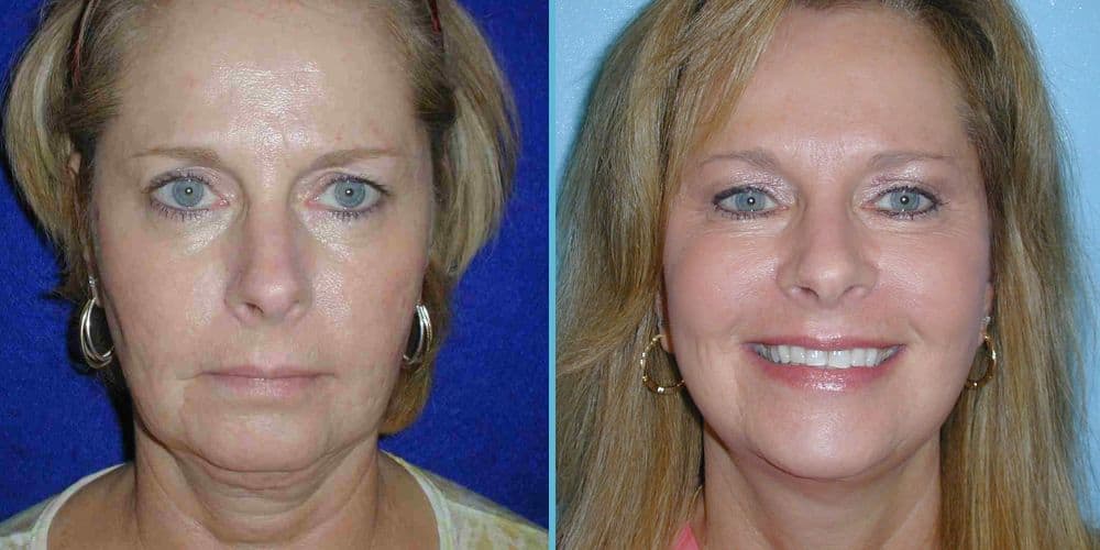 Facelift Surgery Photos