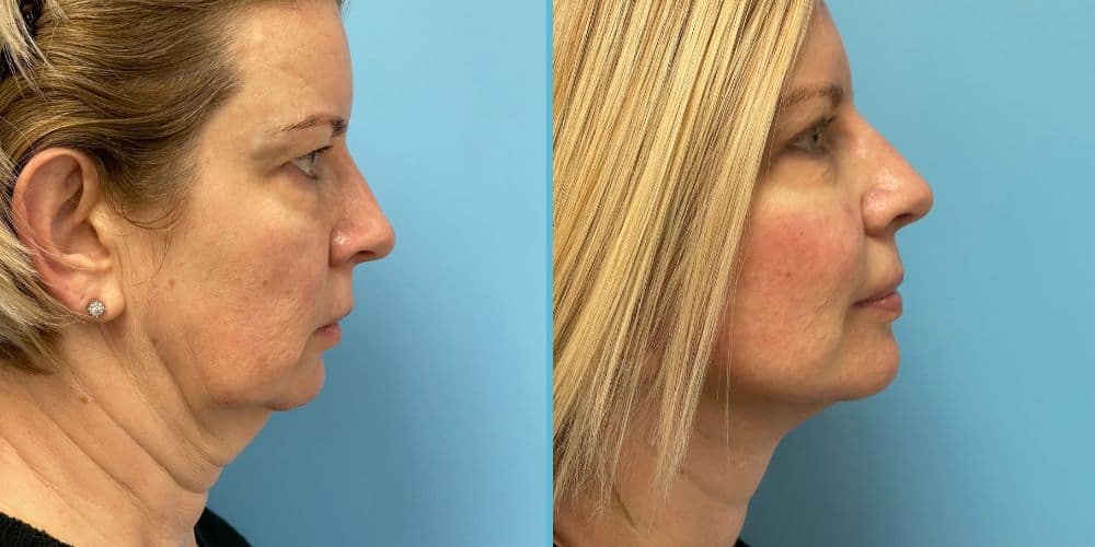 Facelift Surgery Photos