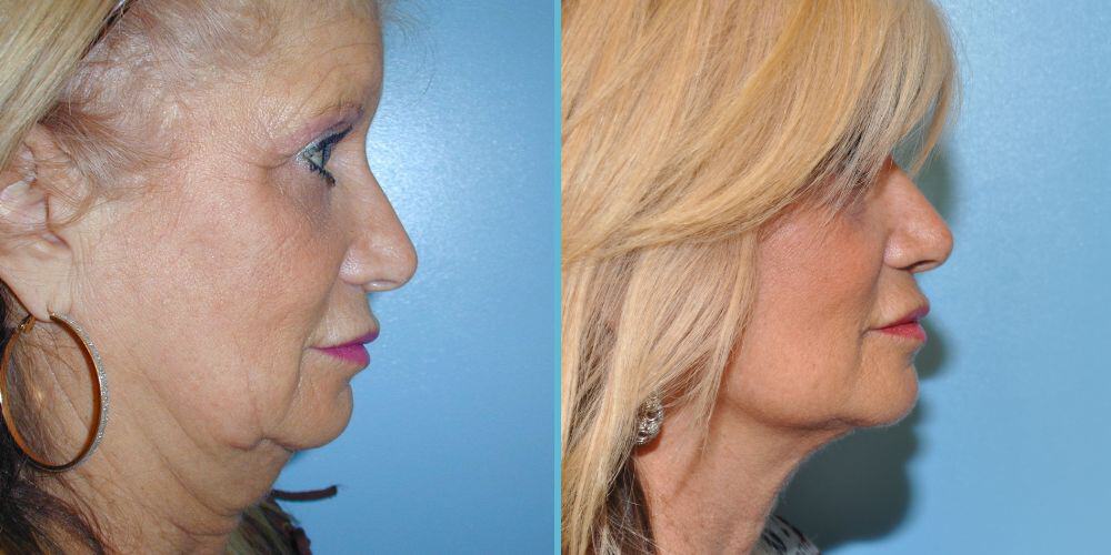 Facelift Surgery Photos