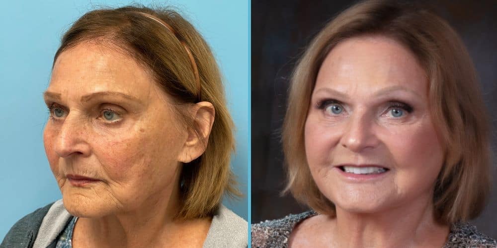 Facelift Surgery Photos