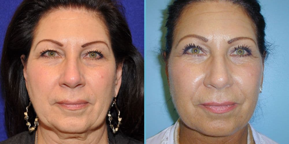 Facelift Surgery Photos