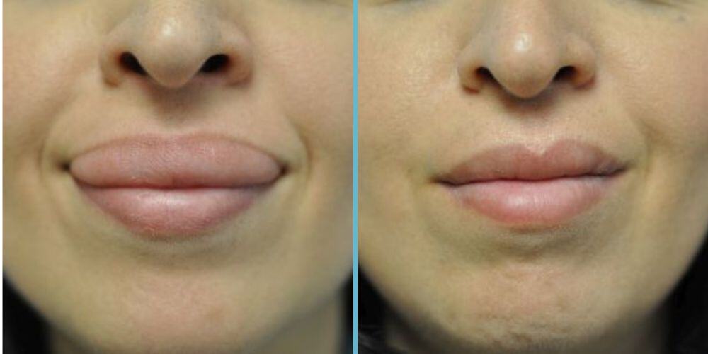 Lip Reduction Photos