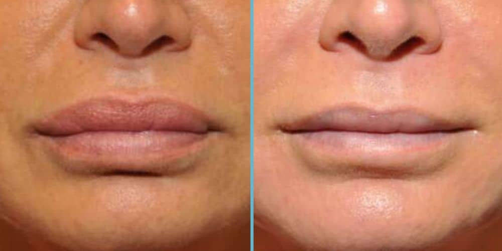 Lip Reduction Photos