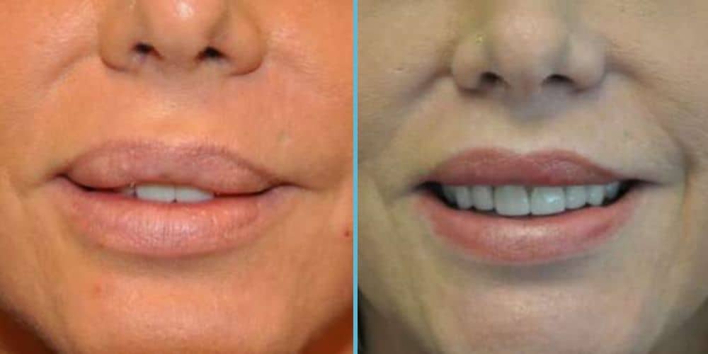 Lip Reduction Photos