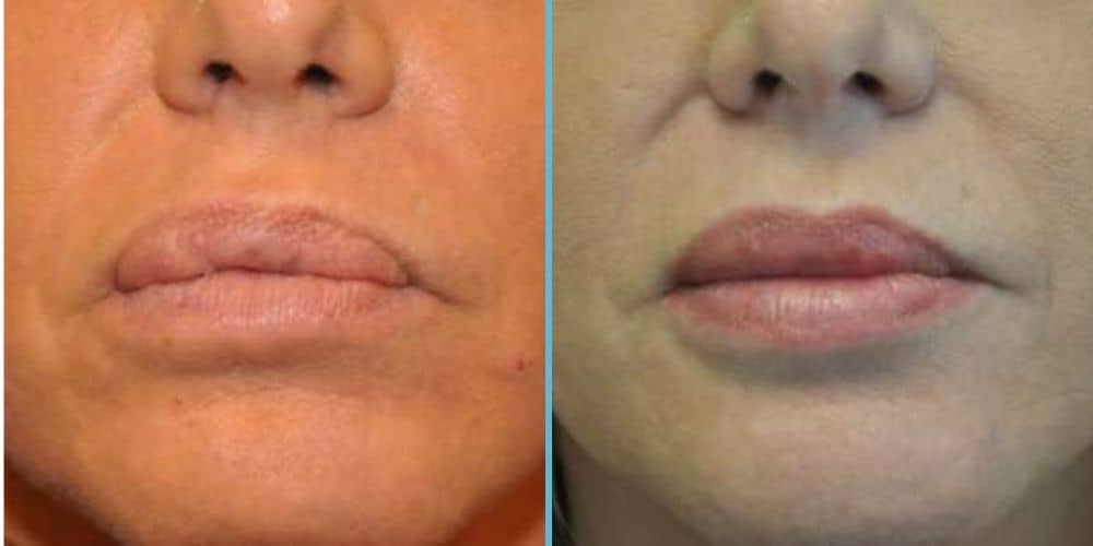 Lip Reduction Photos