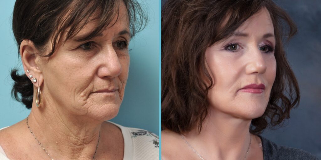 Facelift Surgery Photos