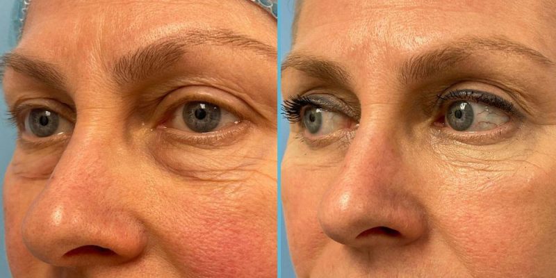 blepharoplasty-before-after-5