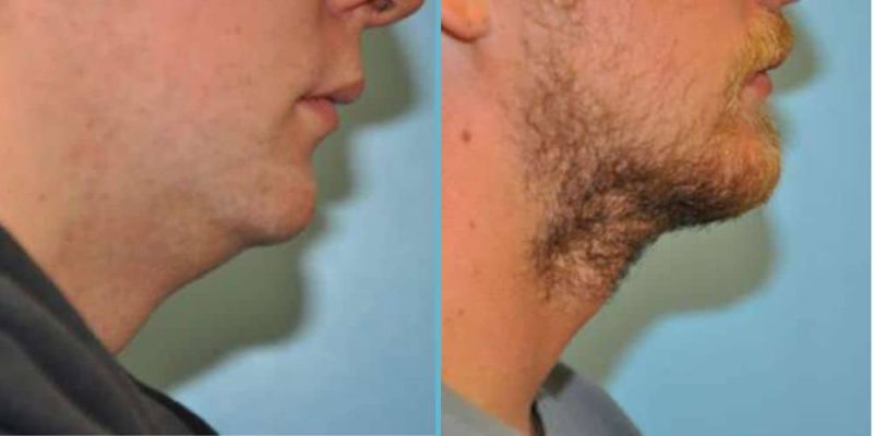 chin-implant-before-after-5