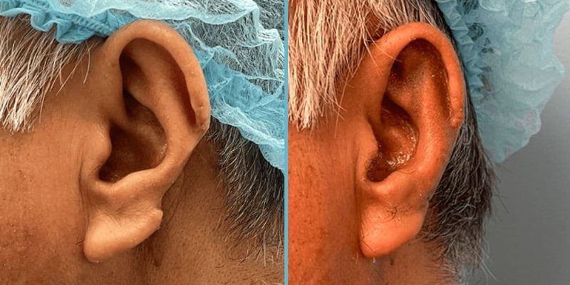 ear-reconstruction-before-after