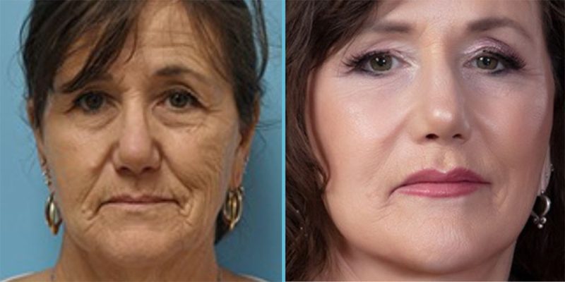 facelift before and after photo