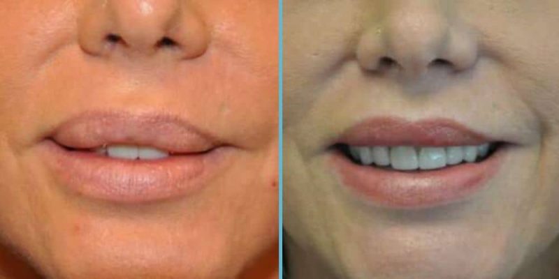 lip-reduction-before-after-6