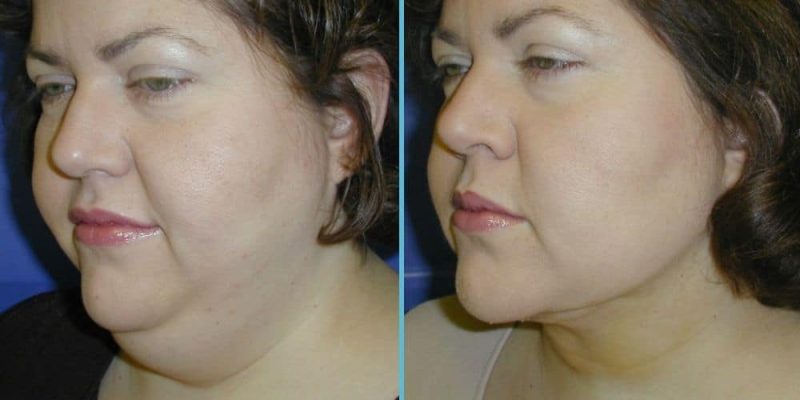 neck-liposuction-before-after-3