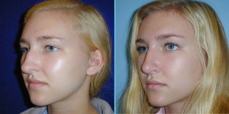 rhinoplasty-before-after