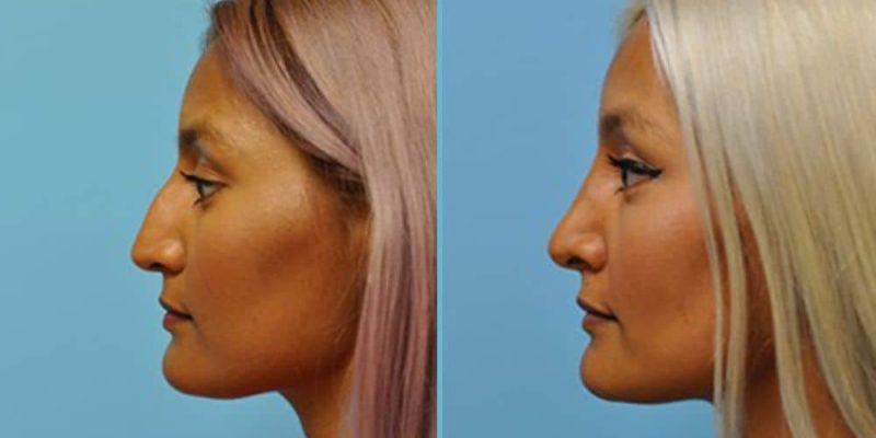 rhinoplasty-featured-image-1