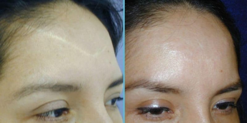 scar-revision-before-after-7