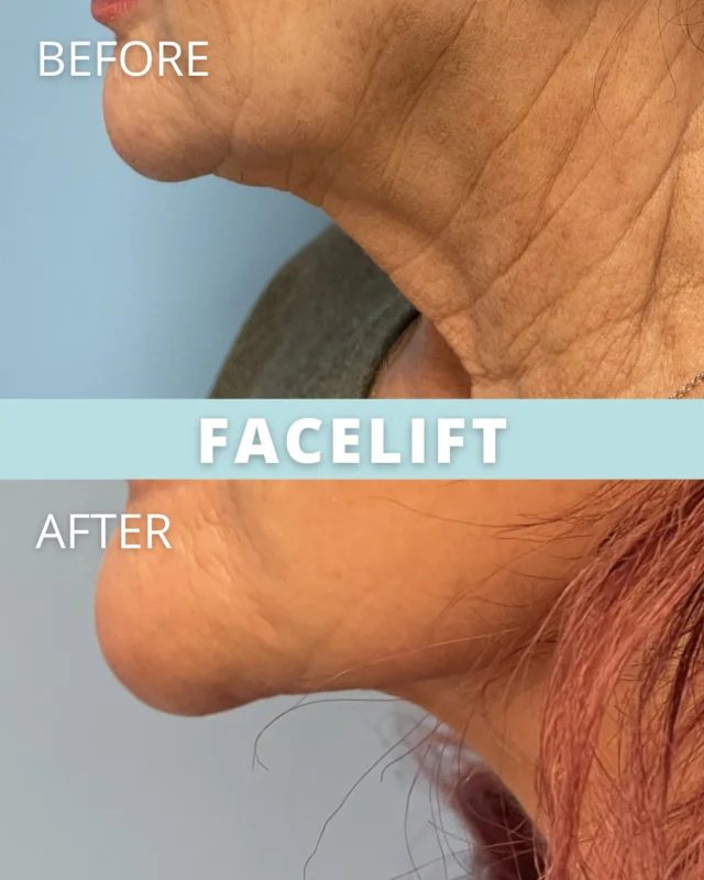 Facial Scar Removal - Facial Scar Treatment - Reduce Scars on Face